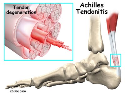 orthotics for achilles tendonitis. Achilles Tendon Wikipedia and
